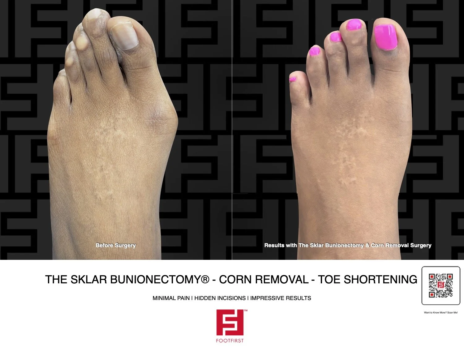 FF  www.footfirst.com - Bunion, Corns & Toe Shortening 01.2026 THO 178.jpg.jpeg