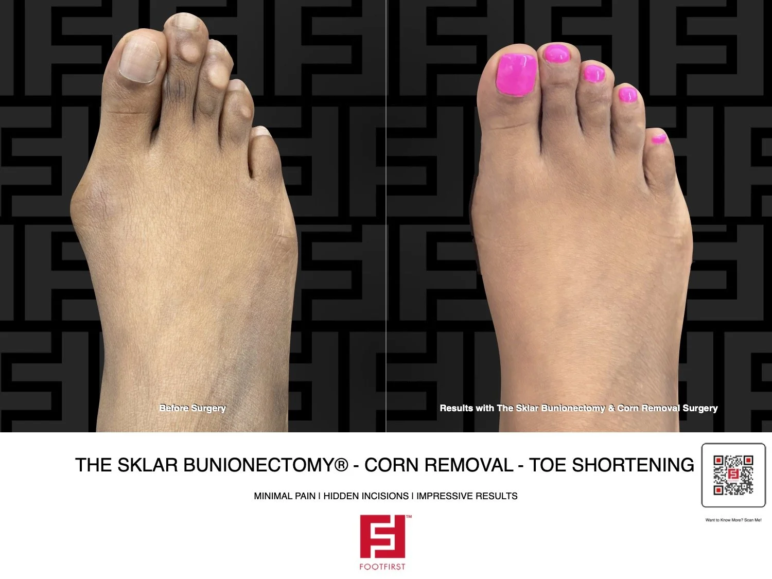 FF  www.footfirst.com - Bunion, Corns & Toe Shortening 01.2026179.jpg