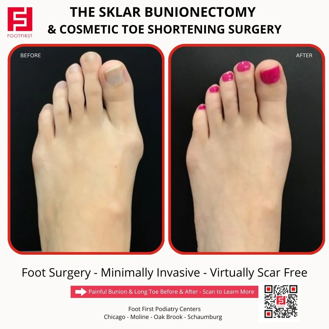 Toe-Shortening-Surgery-Travel-Patient-Before-and-After-Chicago-(2).jpg