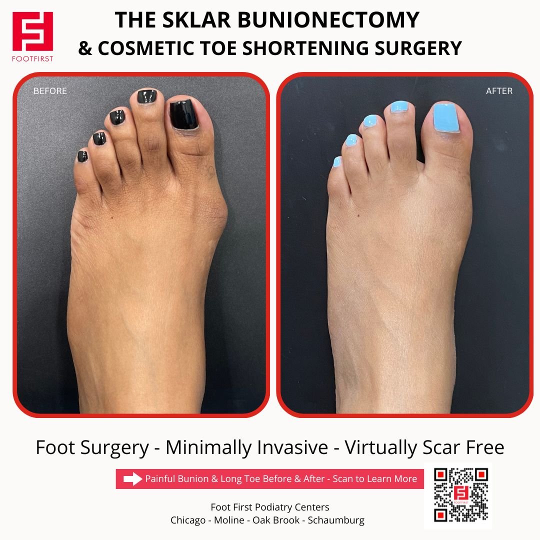 Toe-Shortening-Surgery-Travel-Patient-Before-and-After-Chicago-(6).jpg