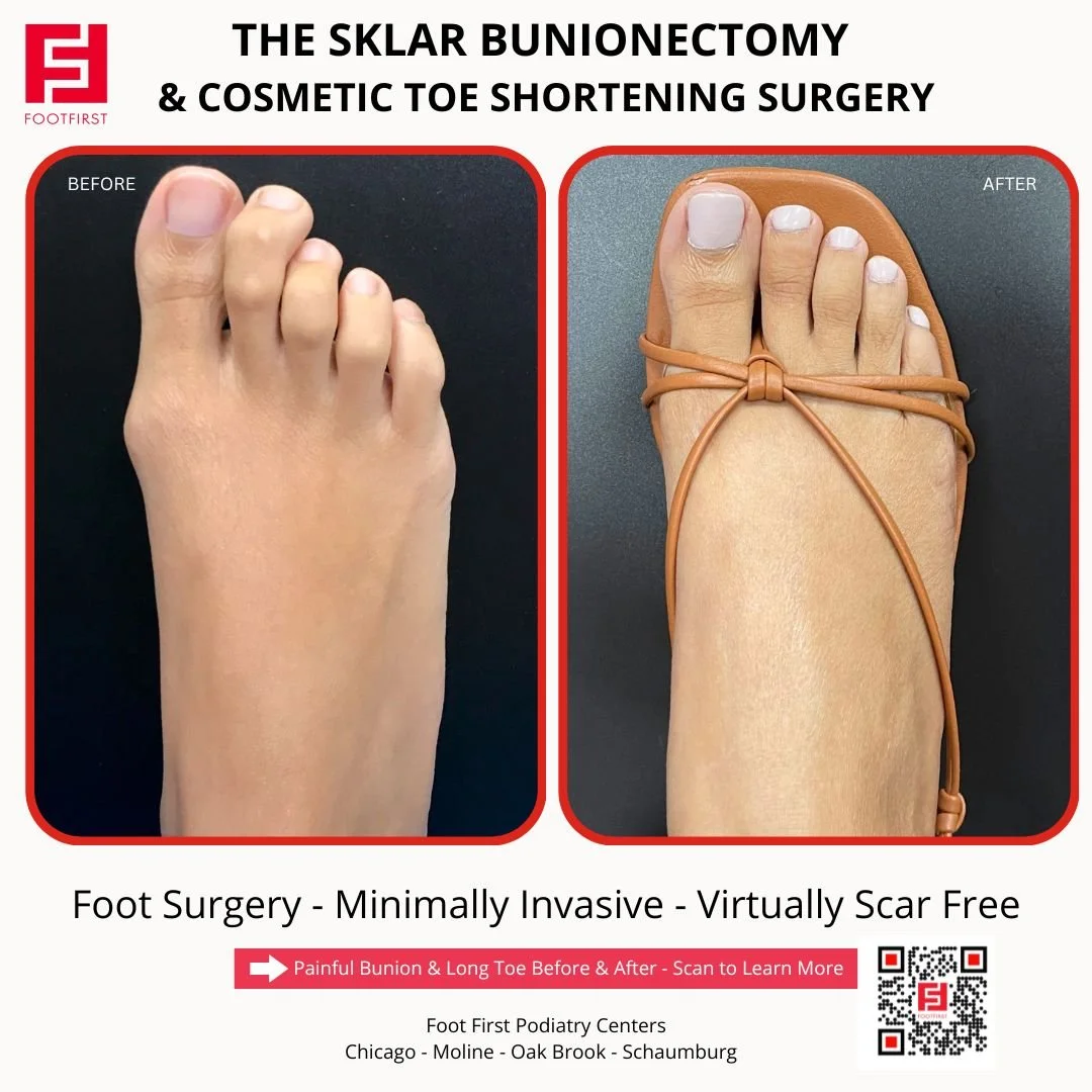 Toe-Shortening-Surgery-Travel-Patient-Before-and-After-Chicago-(3).jpg