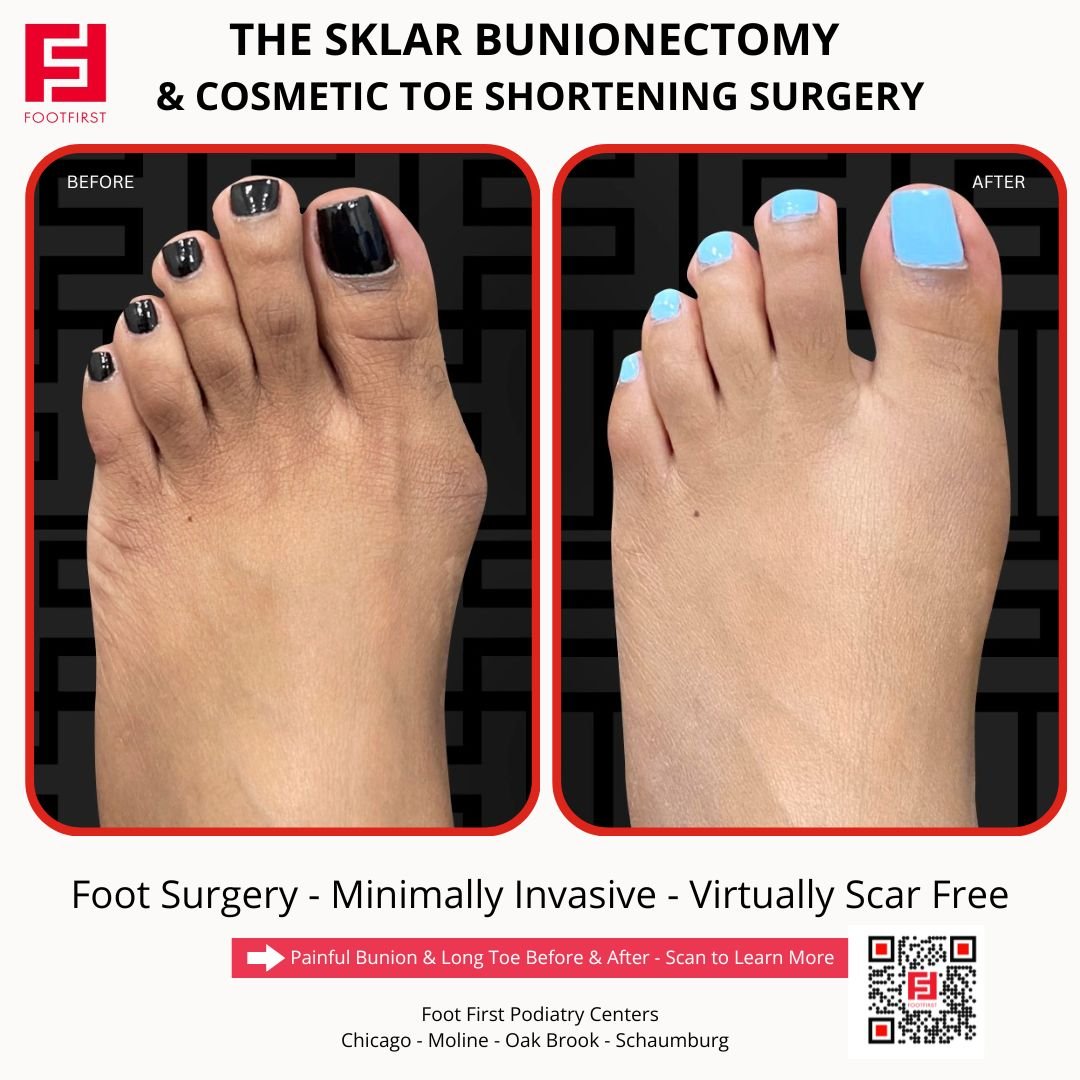 Toe-Shortening-Surgery-Travel-Patient-Before-and-After-Chicago-(4).jpg