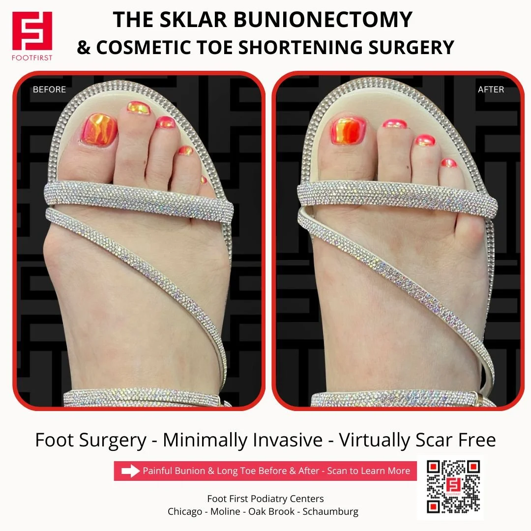 Toe-Shortening-Surgery-Travel-Patient-Before-and-After-Chicago-(5).jpg