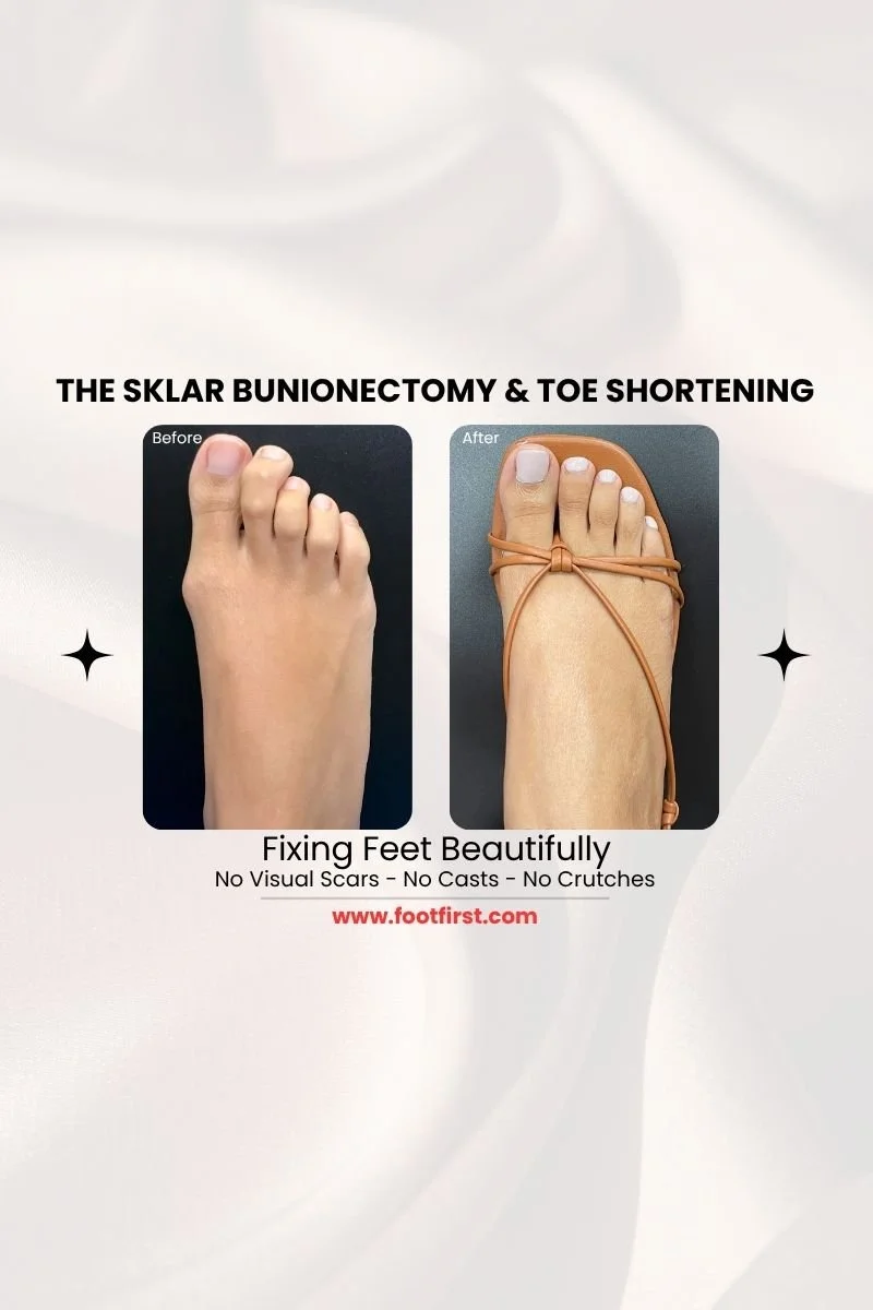 Toe Shortening Surgery in Chicago: Benefits, Recovery and Cosmetic Results