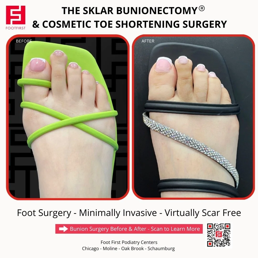 Toe-Shortening-Surgery-Travel-Patient-Before-and-After-Chicago-(1).jpeg