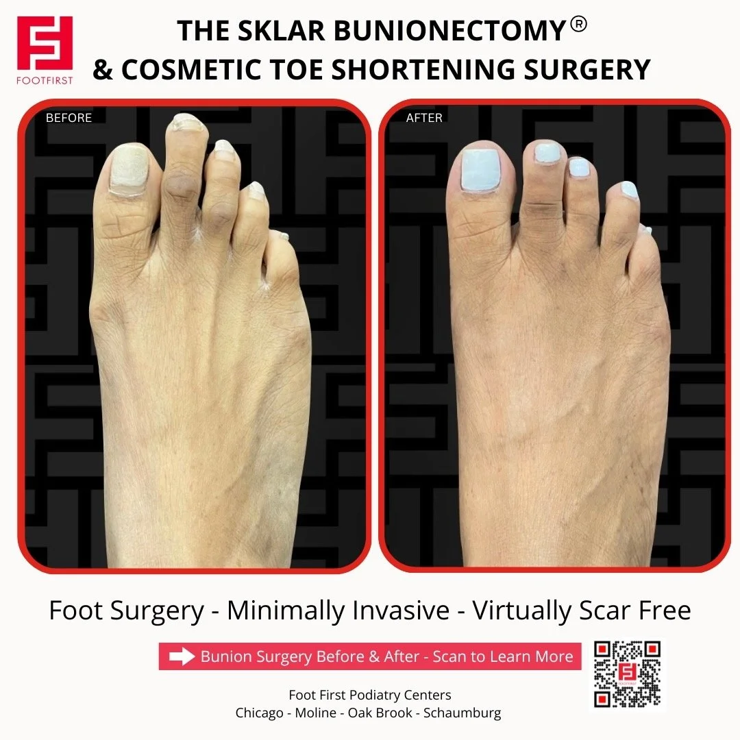Toe-Shortening-Surgery-Travel-Patient-Before-and-After-Chicago-(4).jpeg