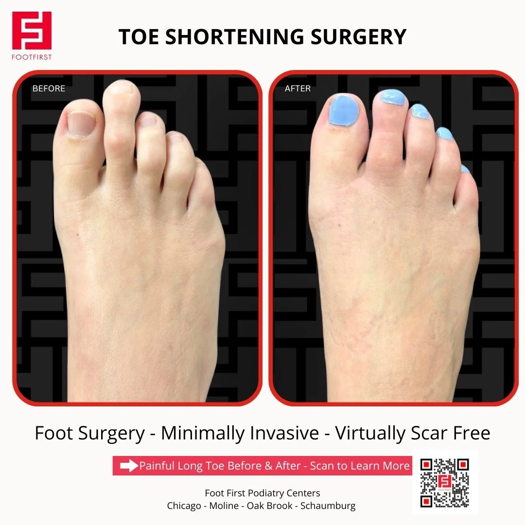 Toe-Shortening-Surgery-Travel-Patient-Before-and-After-Chicago-(6).jpeg