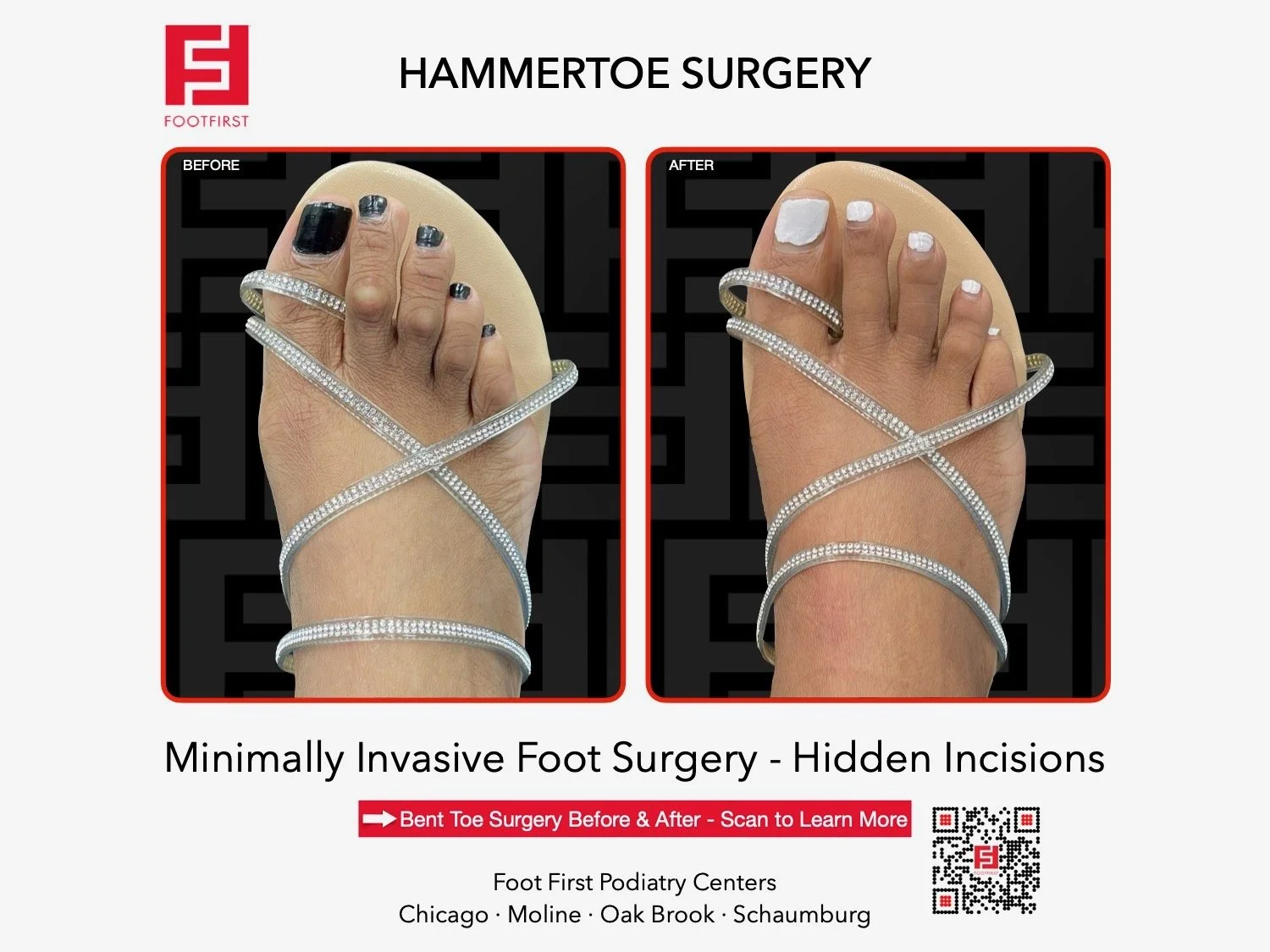 hammertoe-surgery-before-after-chicago-footfirst-(1).jpeg