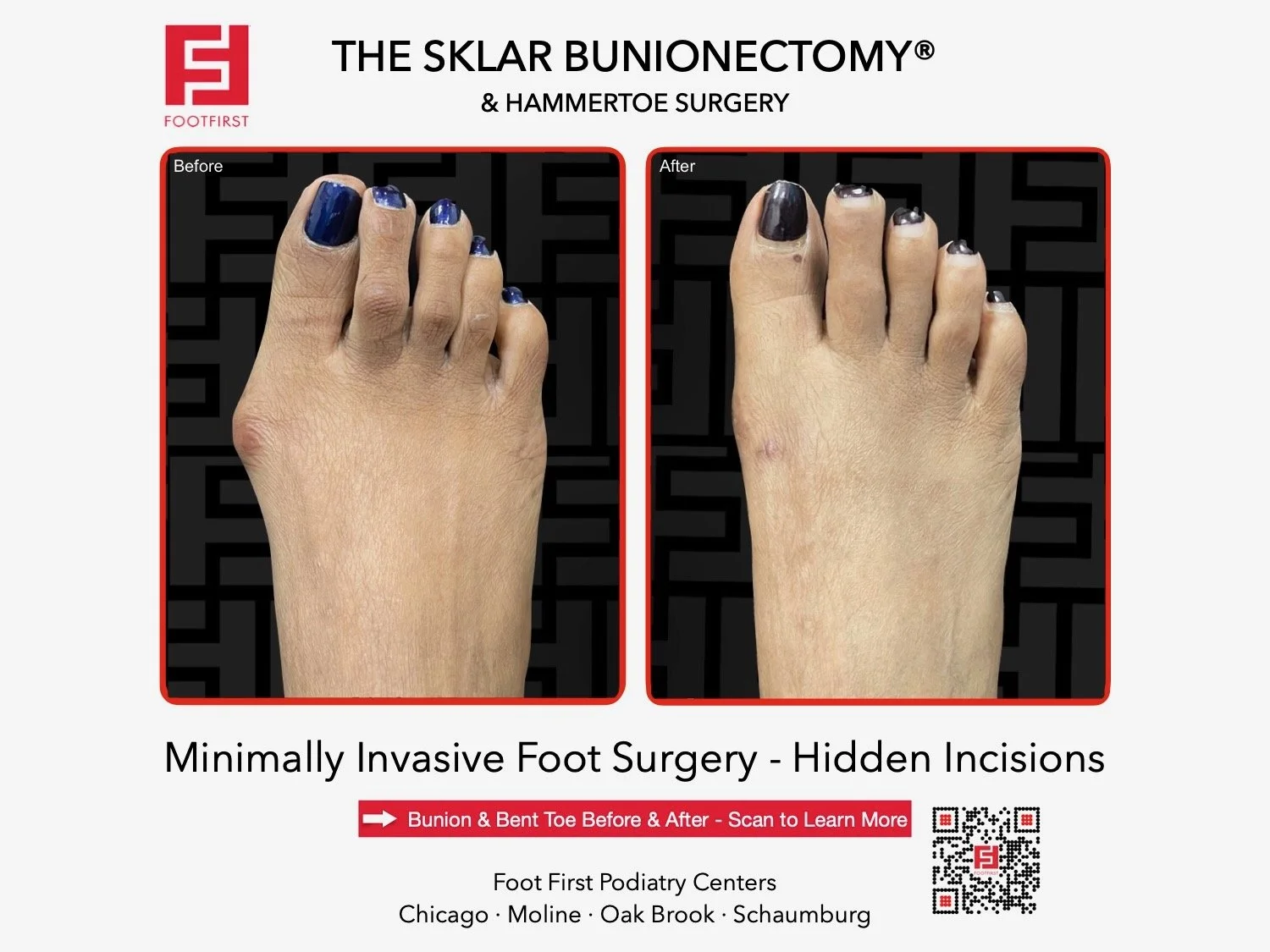 hammertoe-surgery-before-after-chicago-footfirst-(2).jpeg