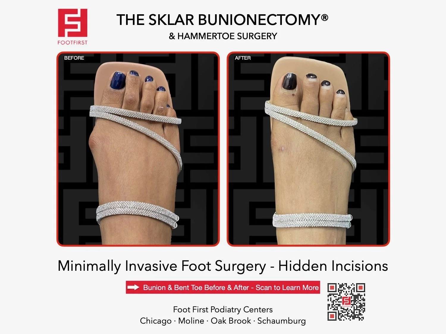 hammertoe-surgery-before-after-chicago-footfirst-(3).jpeg
