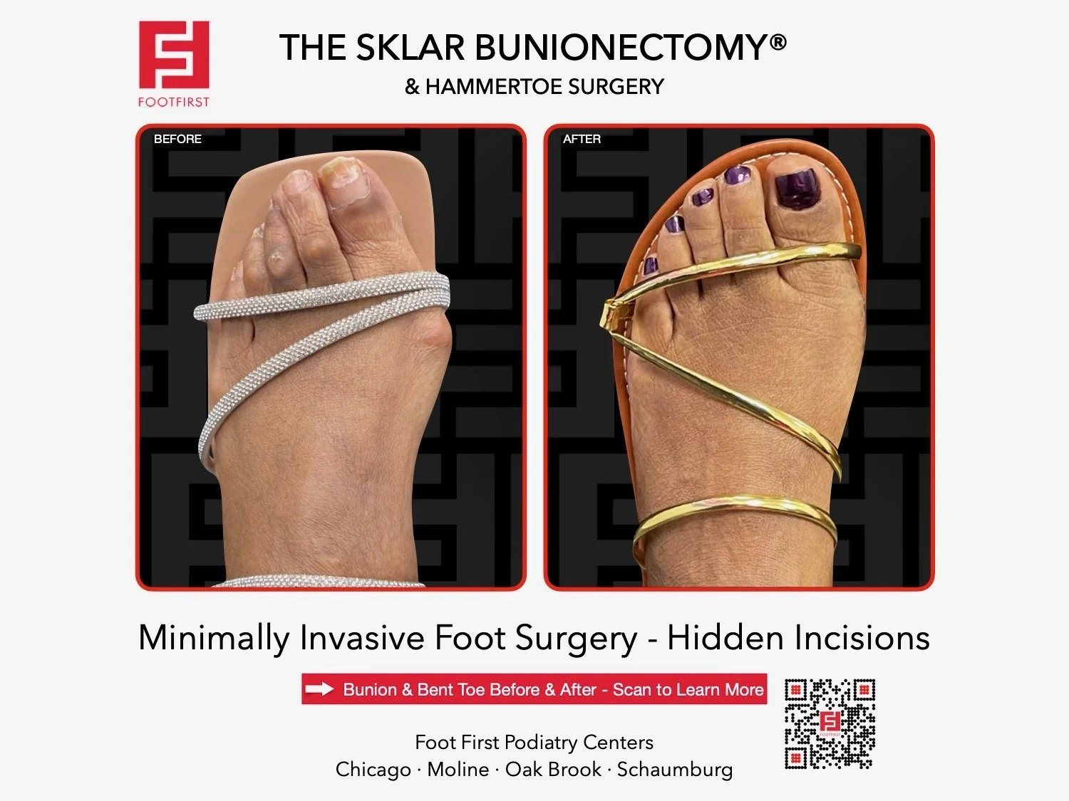 hammertoe-surgery-before-after-chicago-footfirst-(4).jpeg