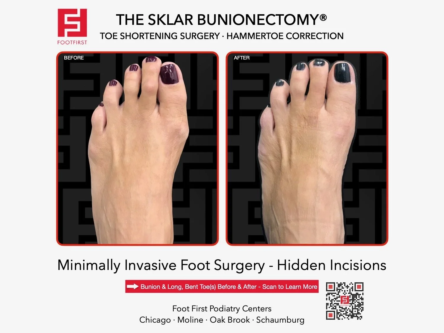 hammertoe-surgery-before-after-chicago-footfirst-(9).jpeg