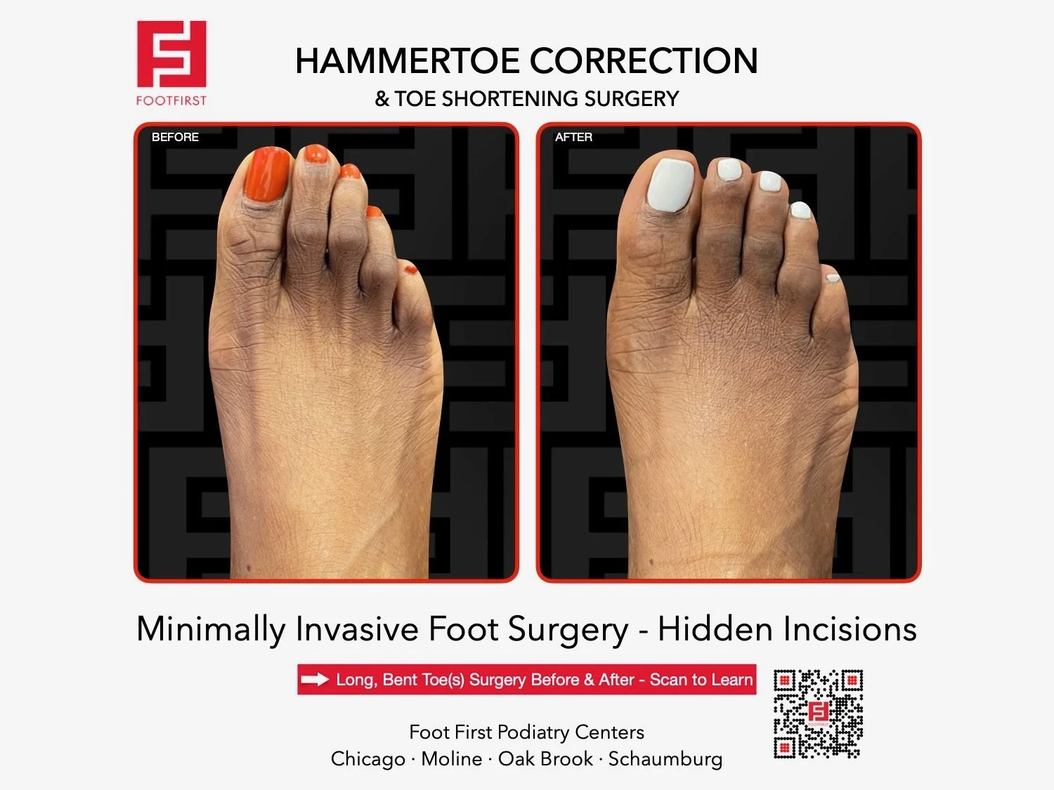 hammertoe-surgery-before-after-chicago-footfirst-(10).jpeg