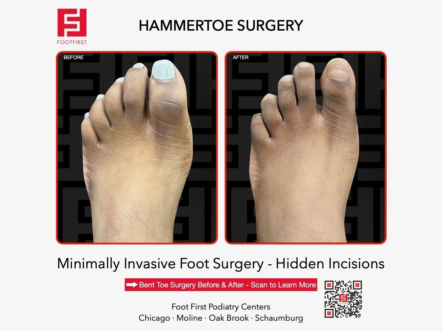 hammertoe-surgery-before-after-chicago-footfirst-(12).jpeg
