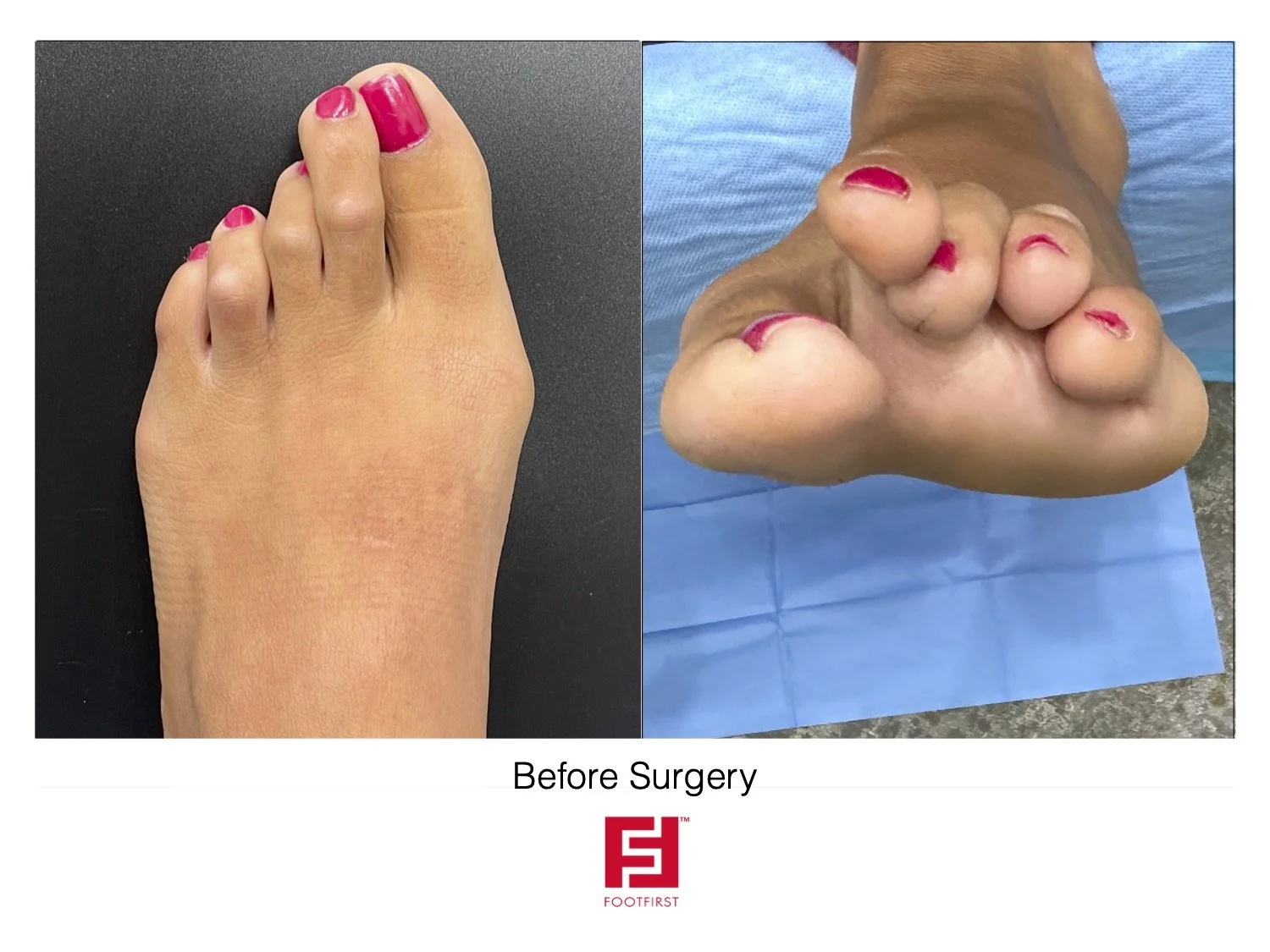 Bunion Surgery Best Shoes For Arch Support And Bunions Bunion