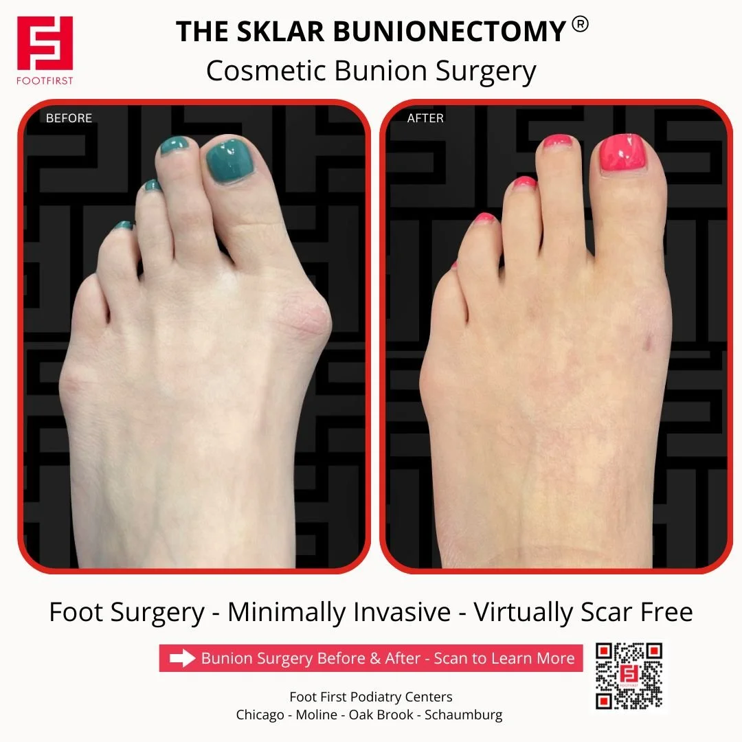 Before and after large bunion correction with The Sklar Bunionectomy® showing significant improvement in bunion prominence and foot alignment.