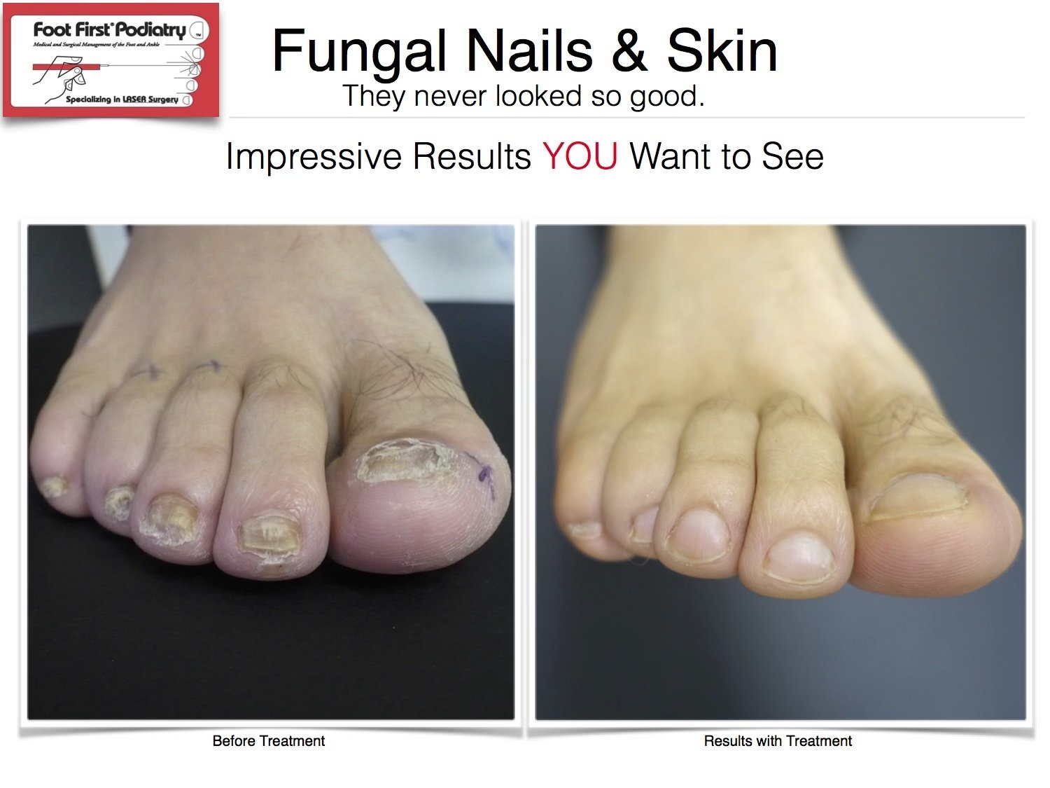 fungal+nails+%7C+www.footfirst.com
