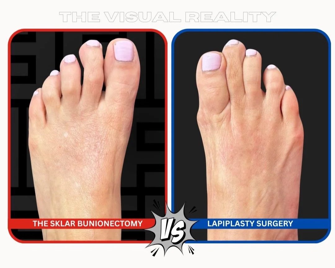 THE SKLAR BUNIONECTOMY VS LAPIPLASTY .jpg