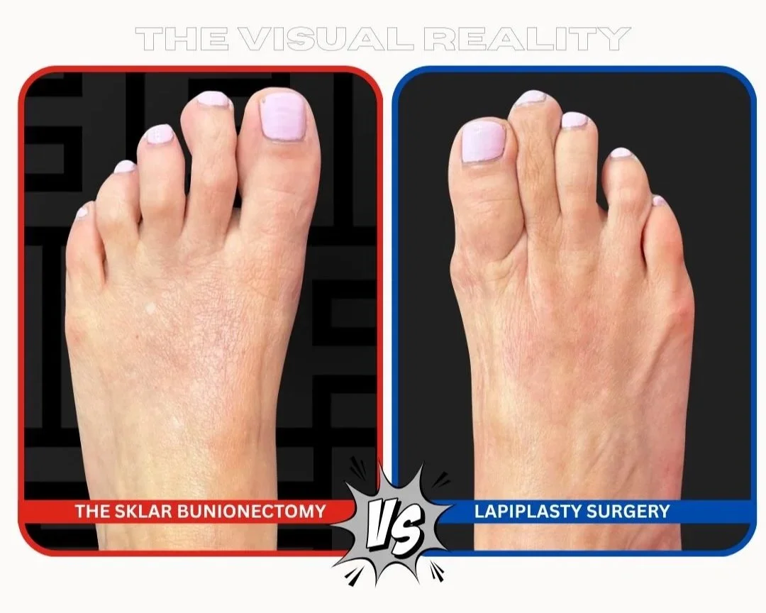 Surgical comparison diagram showing the Sklar Bunionectomy with natural joint preservation versus Lapiplasty 3D surgery with tarsometatarsal joint fusion plates.
