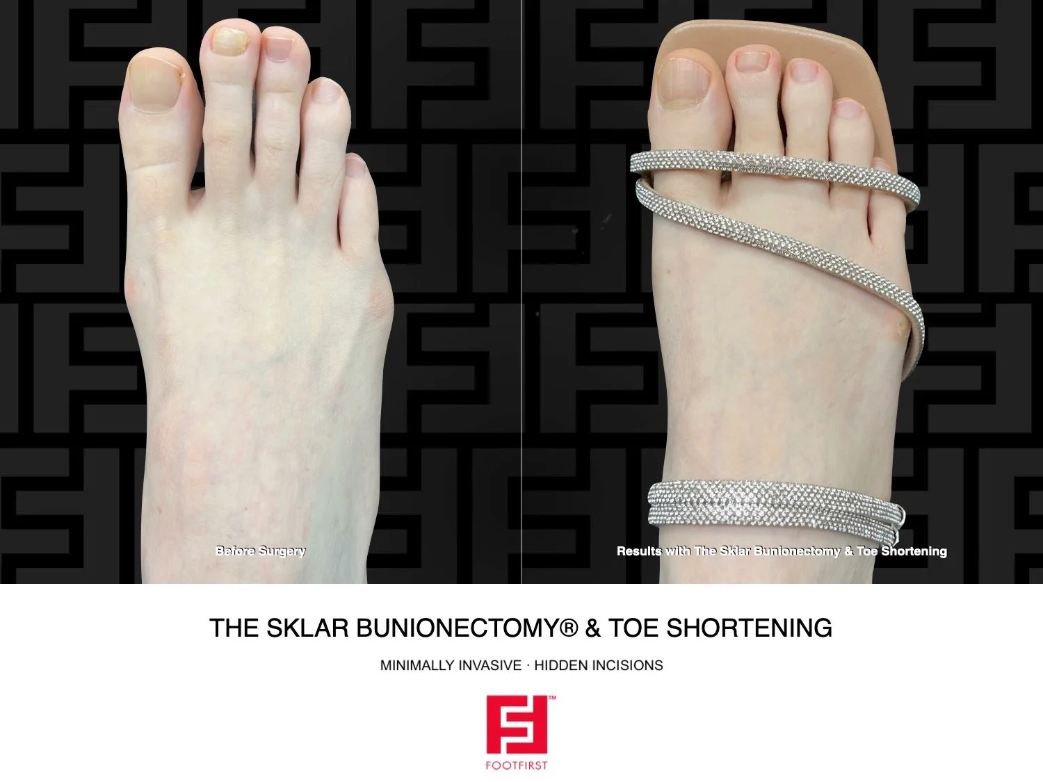 Toe-Shortening-Surgery-Travel-Chicago-Foot-First-Before-and-After