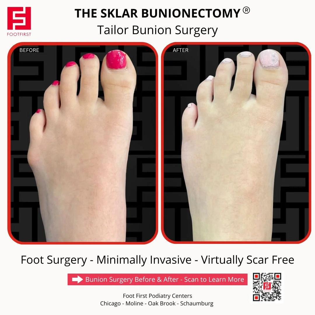 Tailor’s bunion before and after result showing improved fifth metatarsal alignment and correction of the bunionette with The Sklar Bunionectomy®.