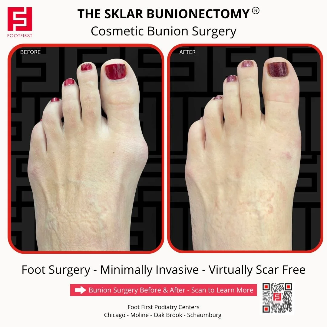 Before and after mild bunion correction with The Sklar Bunionectomy® showing improved big toe alignment and a natural-looking result.