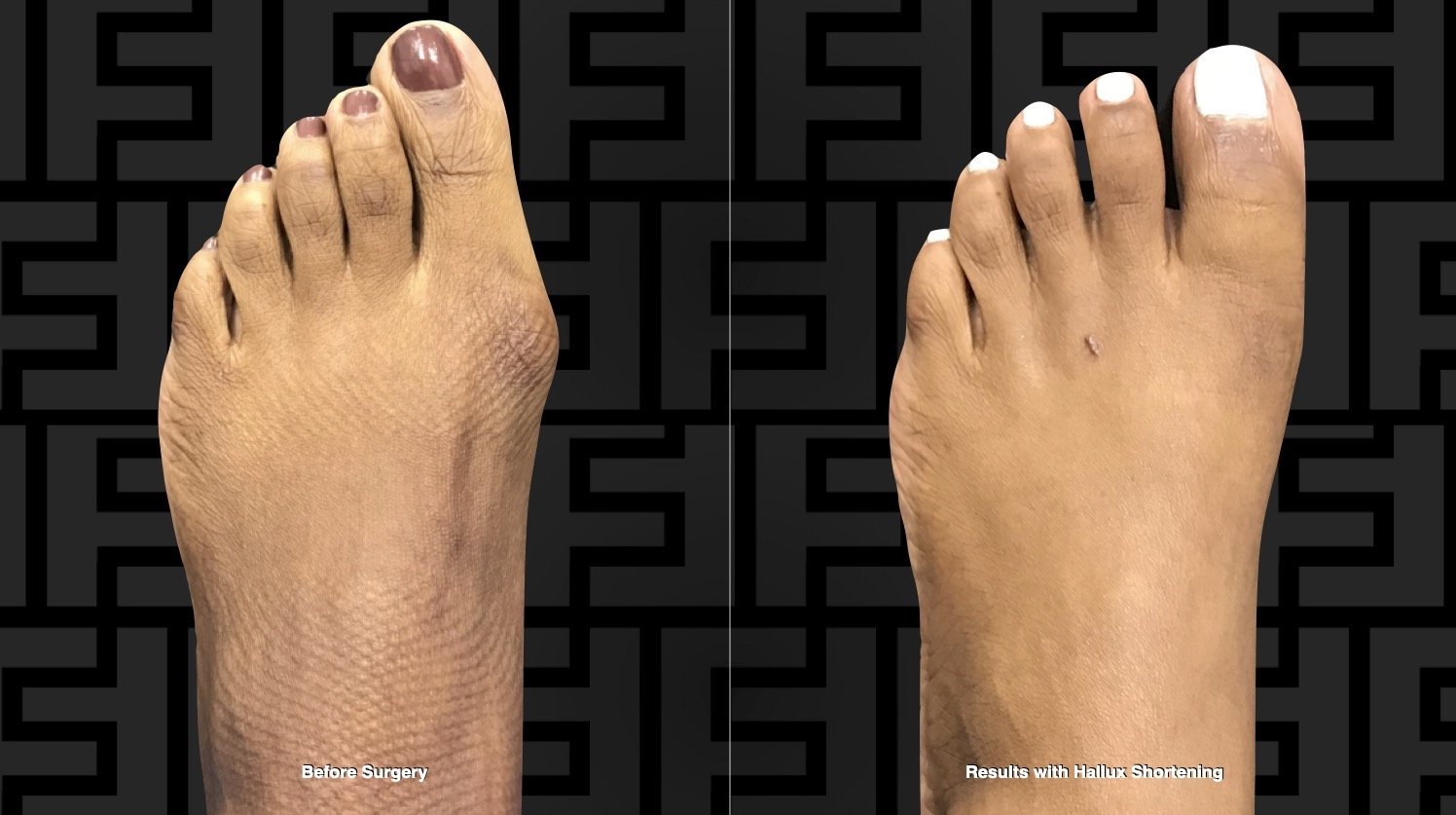 Can you Shorten the Big Toe? — Foot First Podiatry Centers