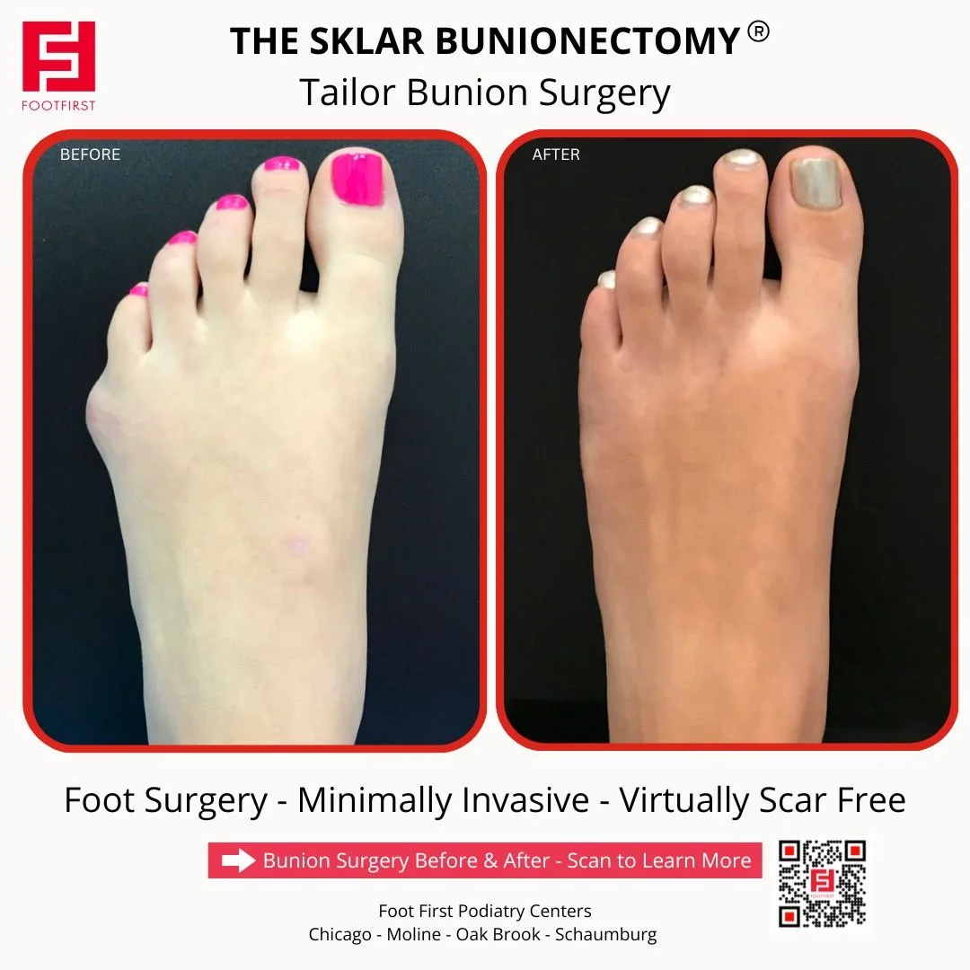 Before and after tailor’s bunion surgery showing correction of a prominent bunionette at the fifth metatarsal with The Sklar Bunionectomy®.