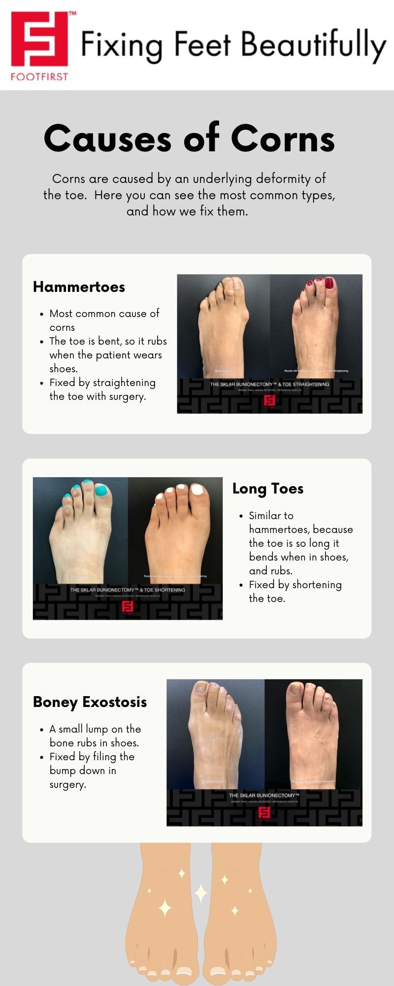 bunions corns calluses