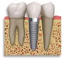 Dental implant