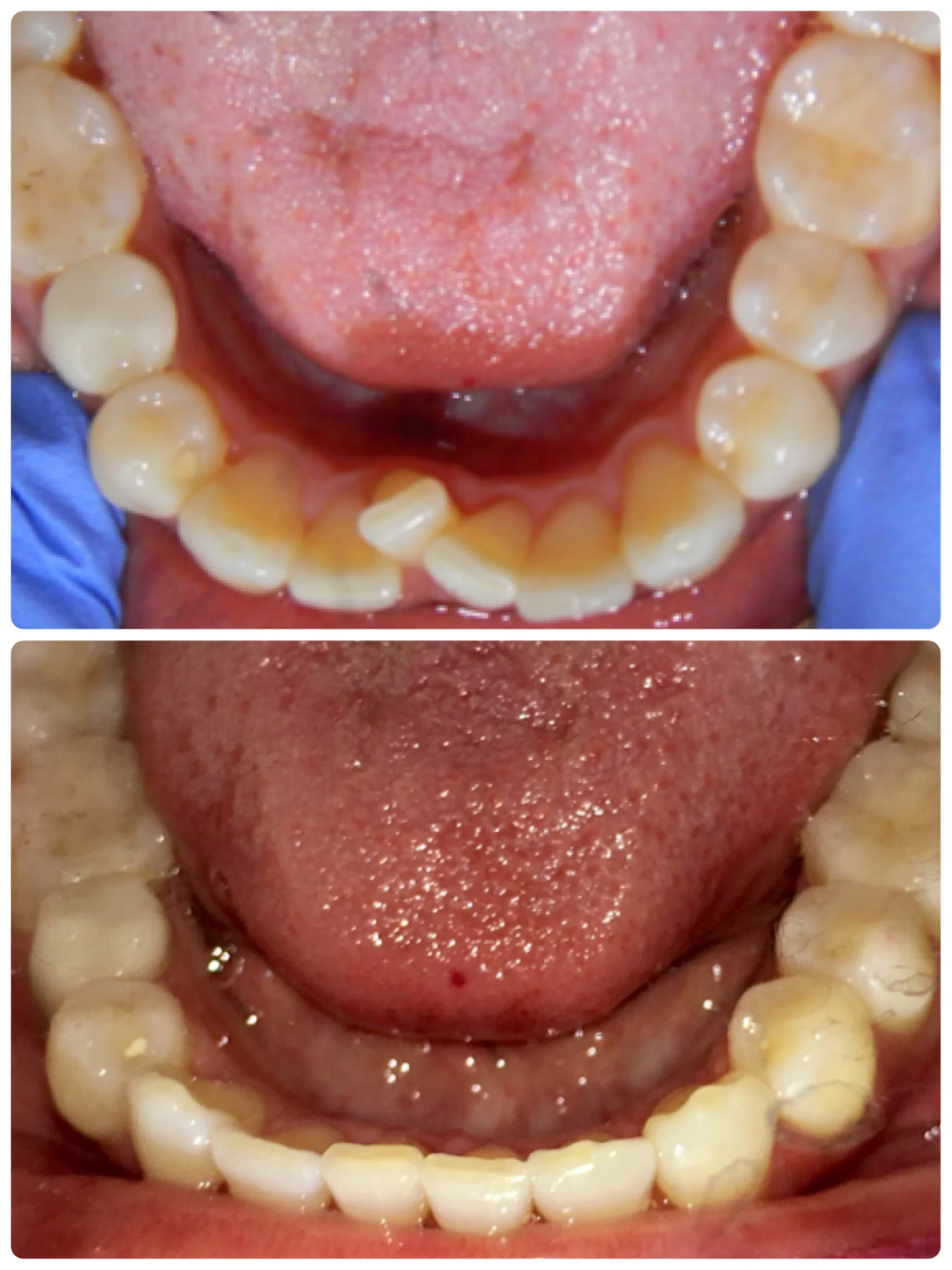 Invisalign in Odenton, MD — Fields Family Dental Odenton's premier