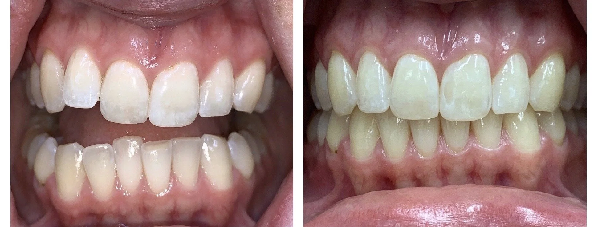 $200 off Invisalign consult - Fields Family Dental- Invisalign Odenton