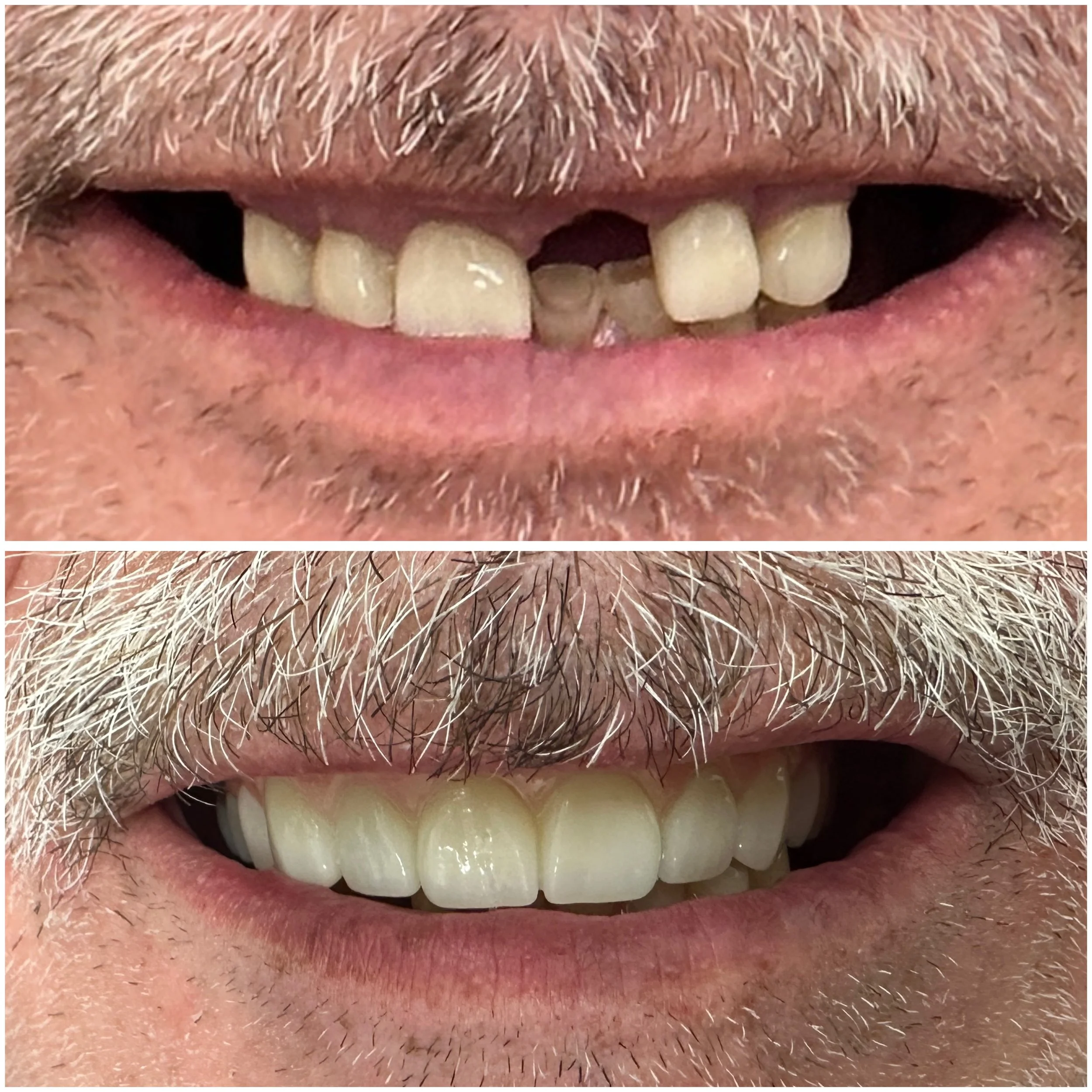 Fixed implant hybrid dentist Odenton - Fields Family Dental