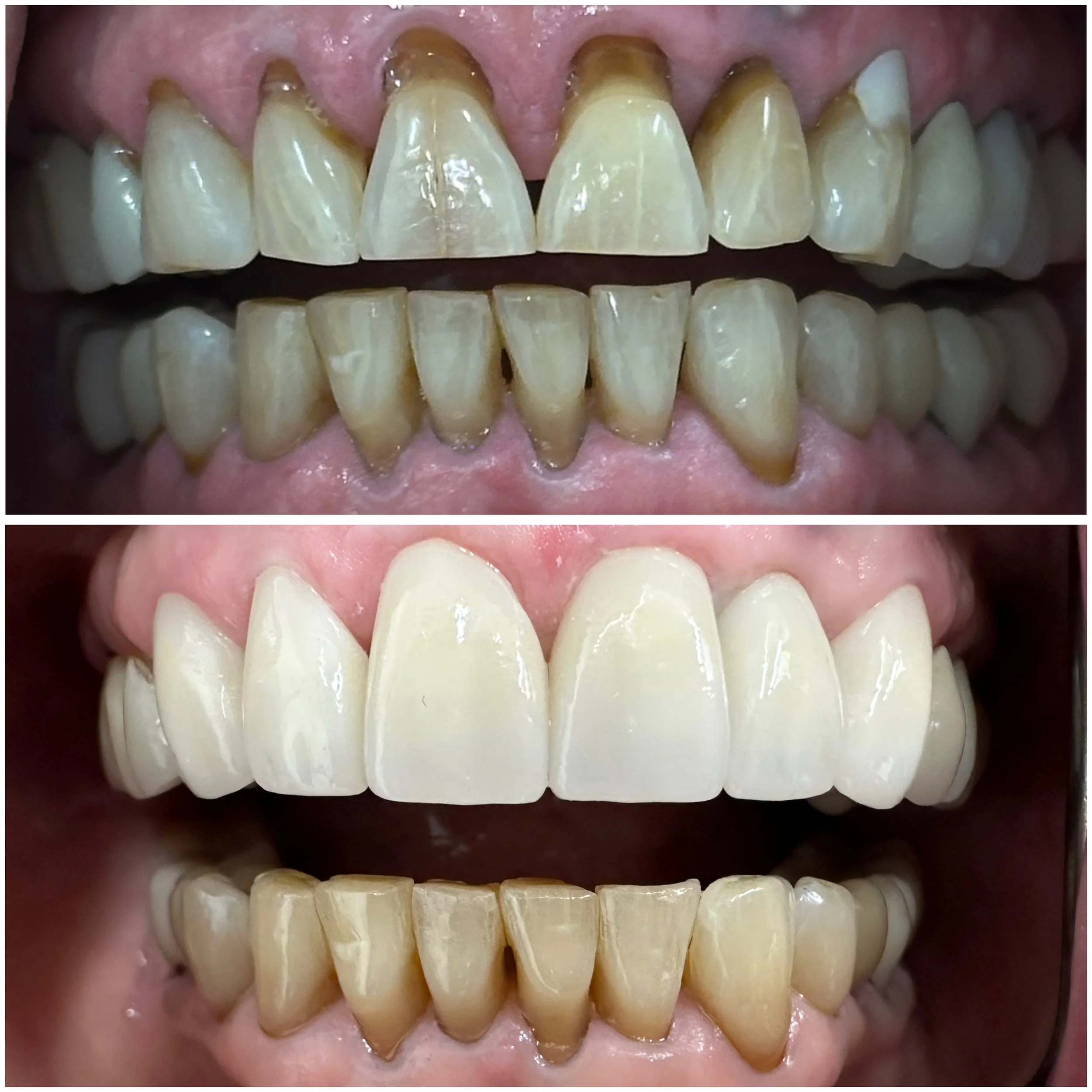 Dentist Odenton Smile makeover - cosmetic crowns and implant crown