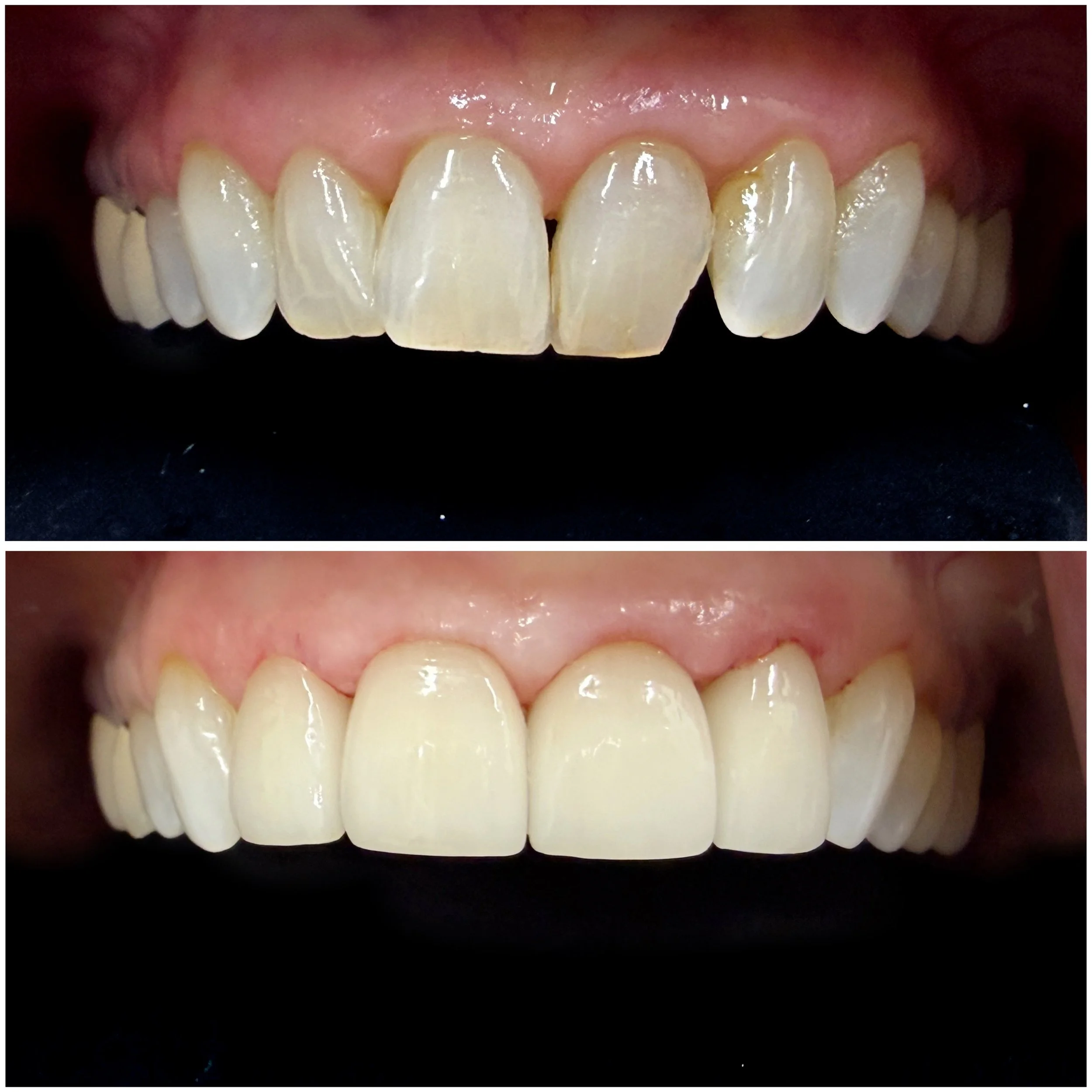 Smile rehabilitation with veneers dentist Odenton, MD