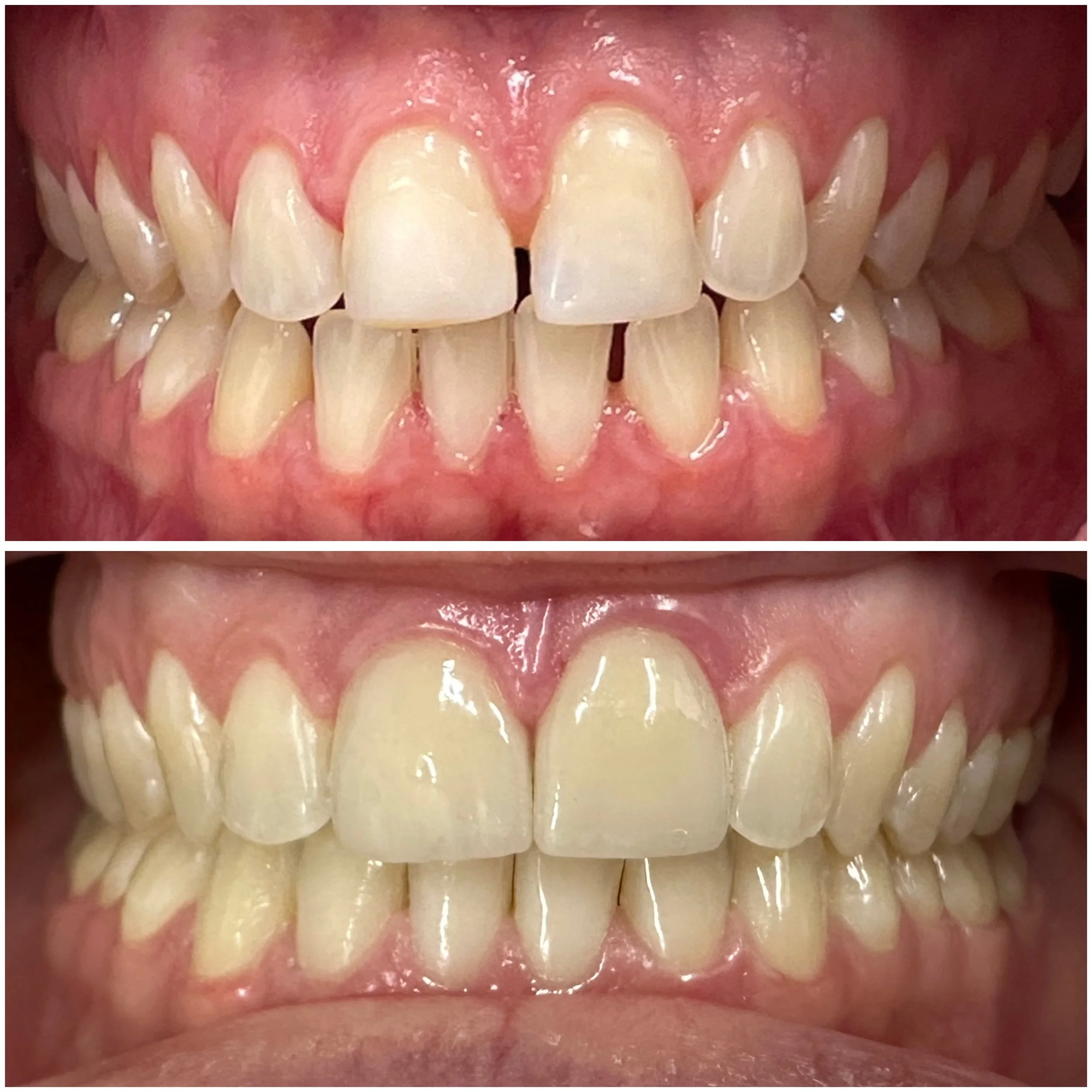 Invisalign with veneers dentist Odenton, MD - Fields Family Dentla