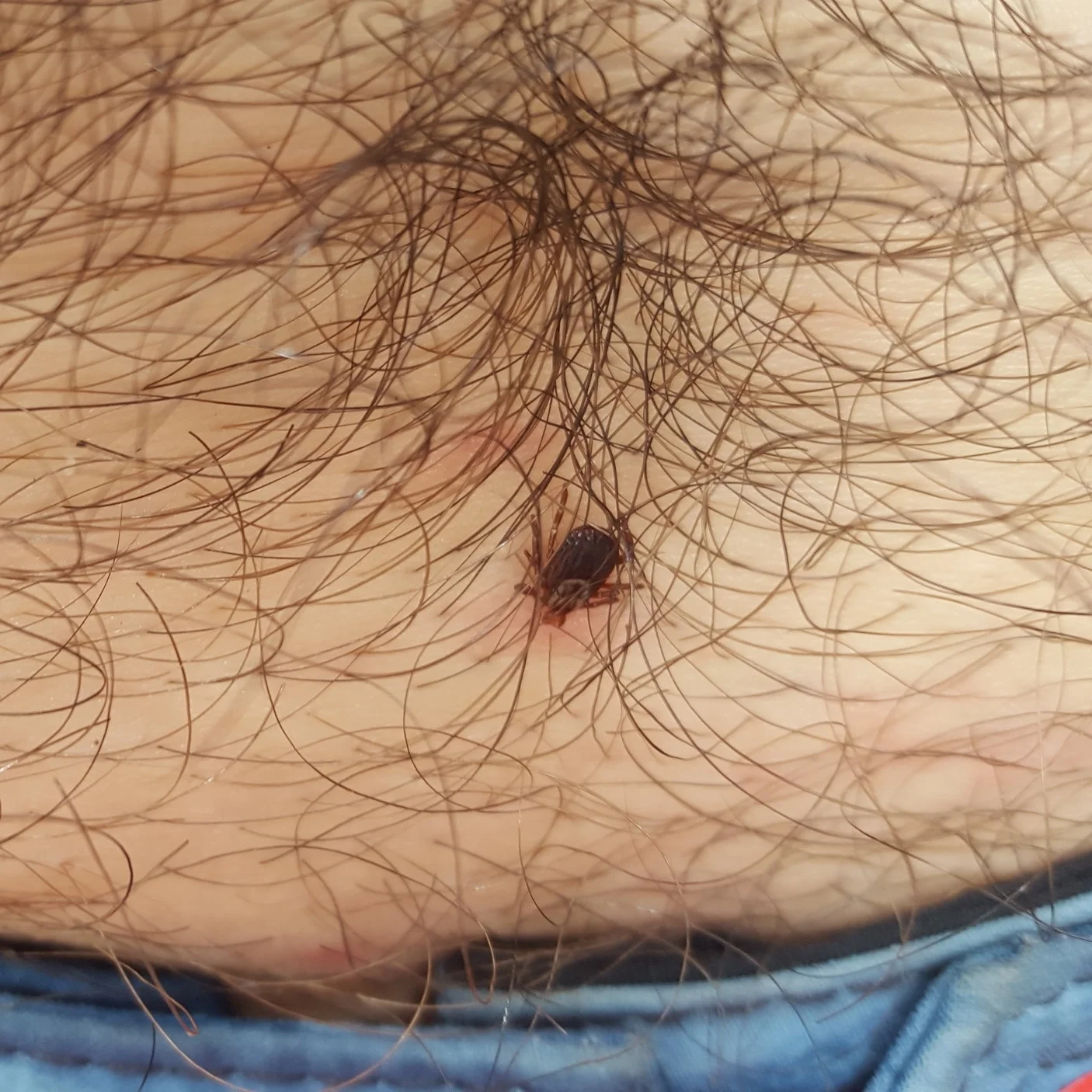 Wood Tick in Temagami 2017