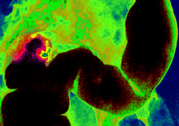 My Cancer Story: Part One