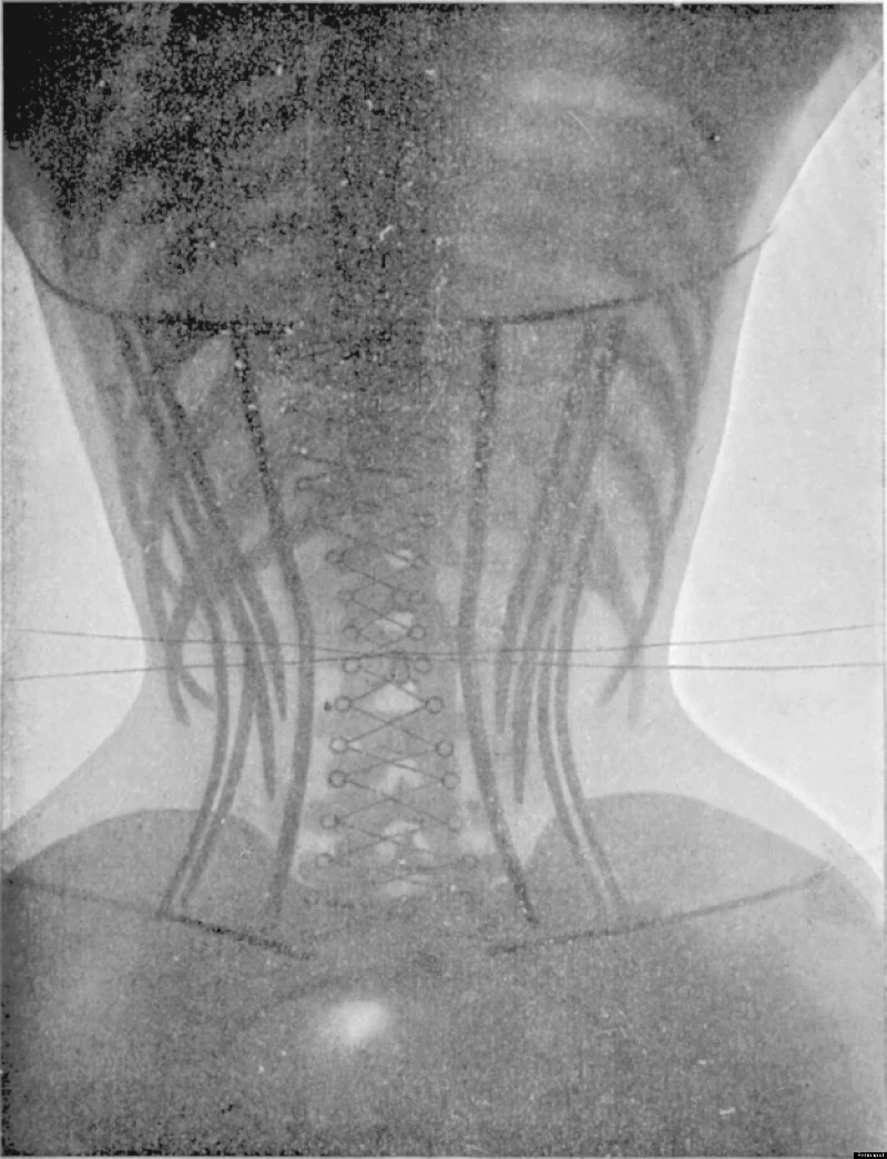 Image 7 / Ludovic O'Followell, X-ray of woman wearing corset, 1908