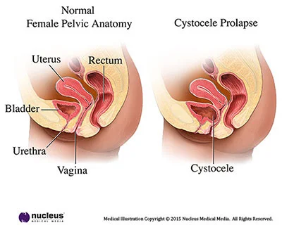 cyst1.jpg