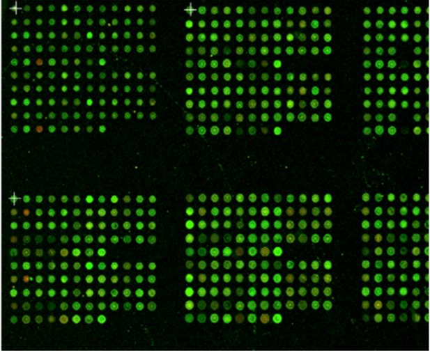 Nirmidas MidaScan™ image showing flourescense of multiple biomarkers for each patient sample