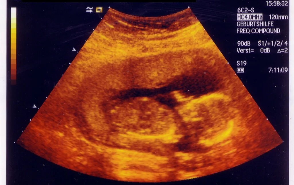  Of Abortions, Miscarriages, and Would-Be Mothers