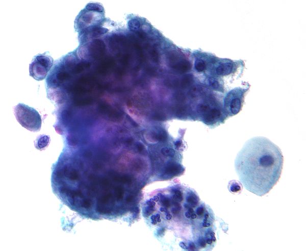 A micrograph of the type of the Adenocarcinoma cancer.