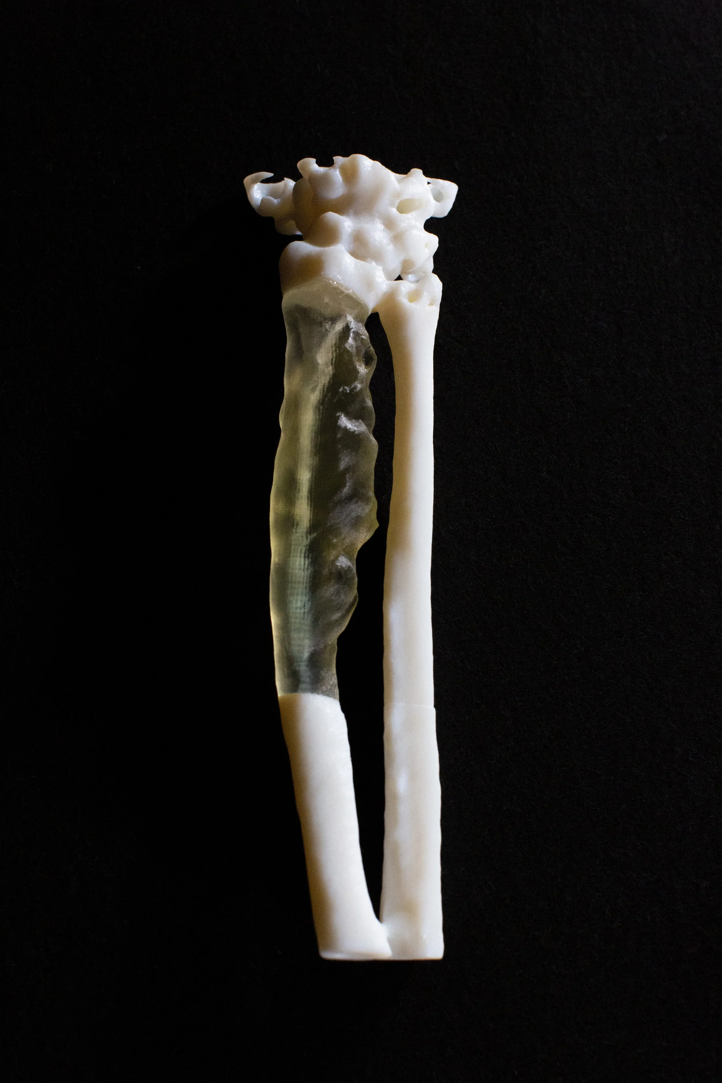 A model used to plan surgery to remove a sarcoma, a cancer of the connective tissue.