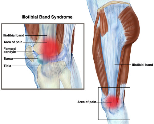 iliotibial tract syndrome