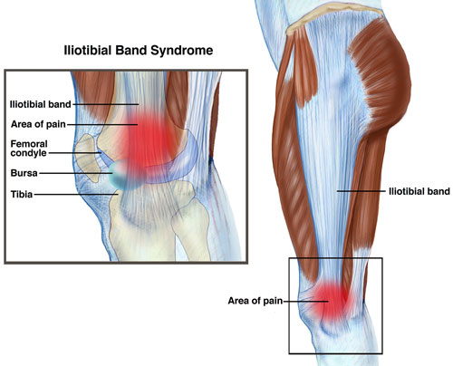 Case Study 11: Iliotibial Band Friction Syndrome - Ankle, Foot and Orthotic  Centre