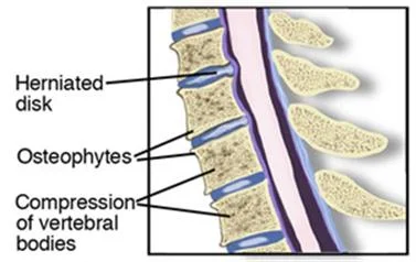 DDD_Cervical_md.jpg
