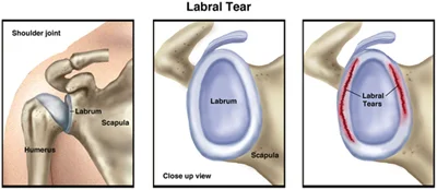 LabralTear_SM.jpg