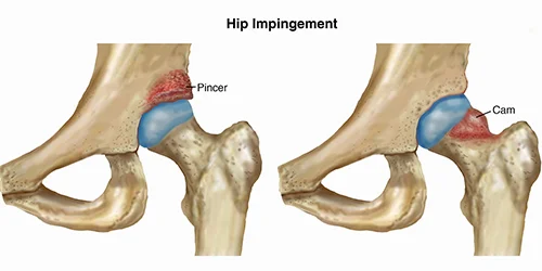 HipImpingement-SM.jpg