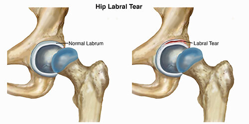 Hip Labral Tears — Pro Dynamic Physical Therapy Inc